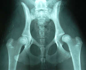dysplazia